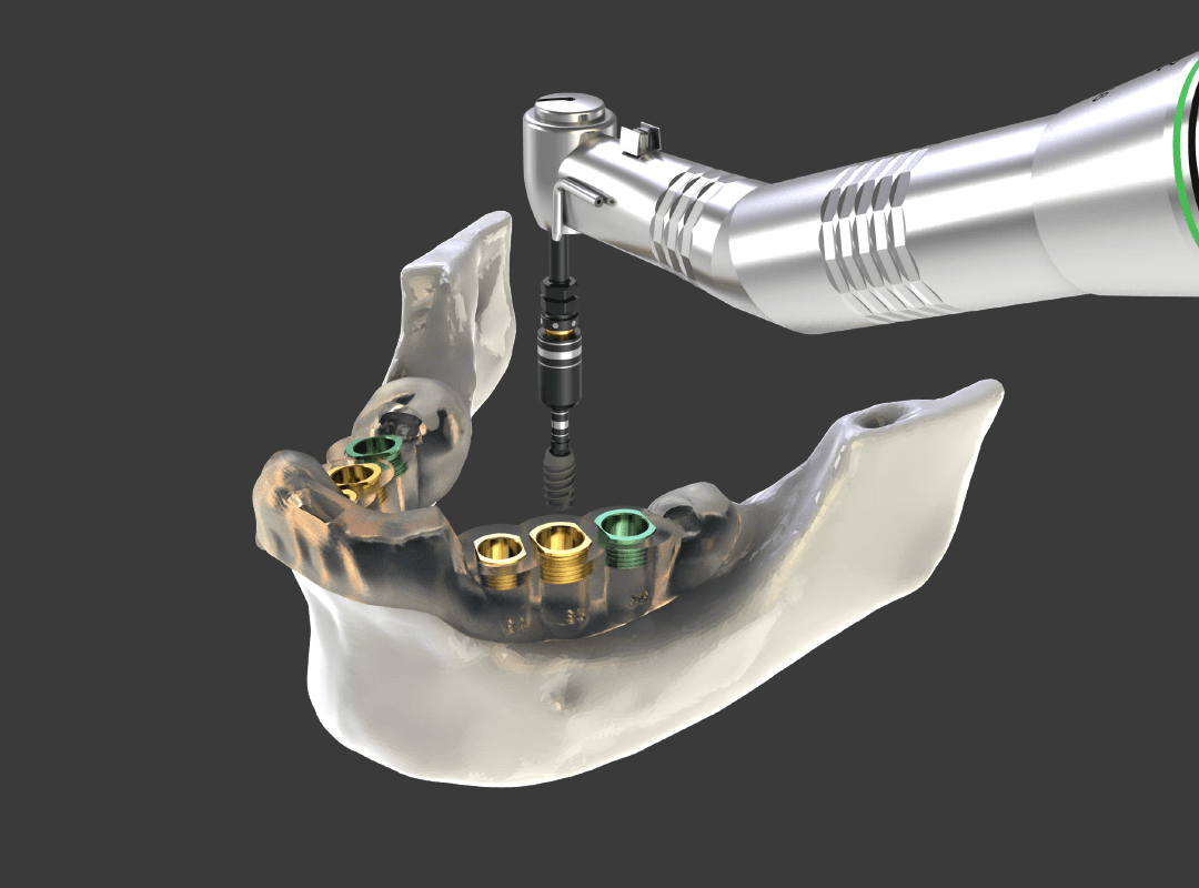 Mandíbula tendo implantes parafusados